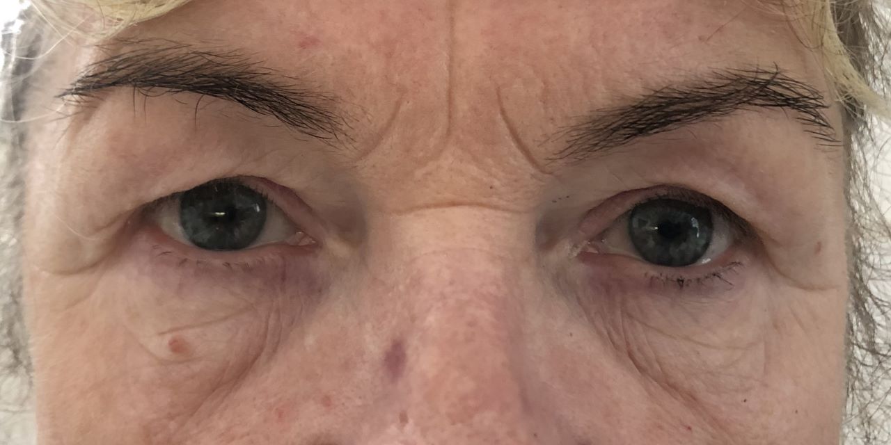 photo effect of the treatment